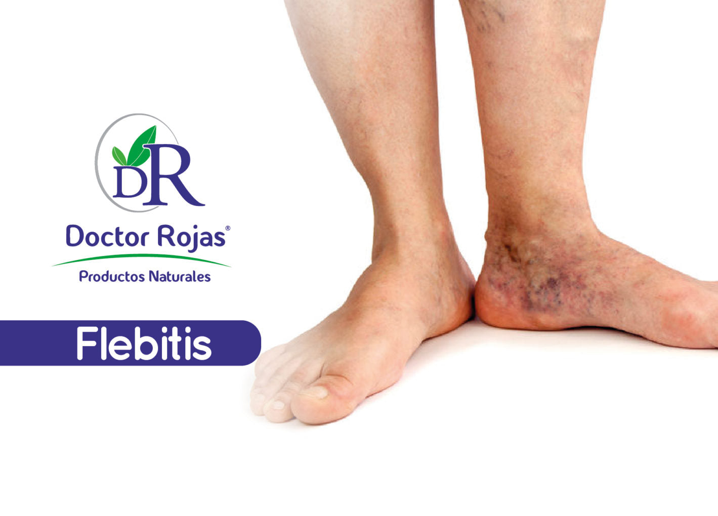Flebitis