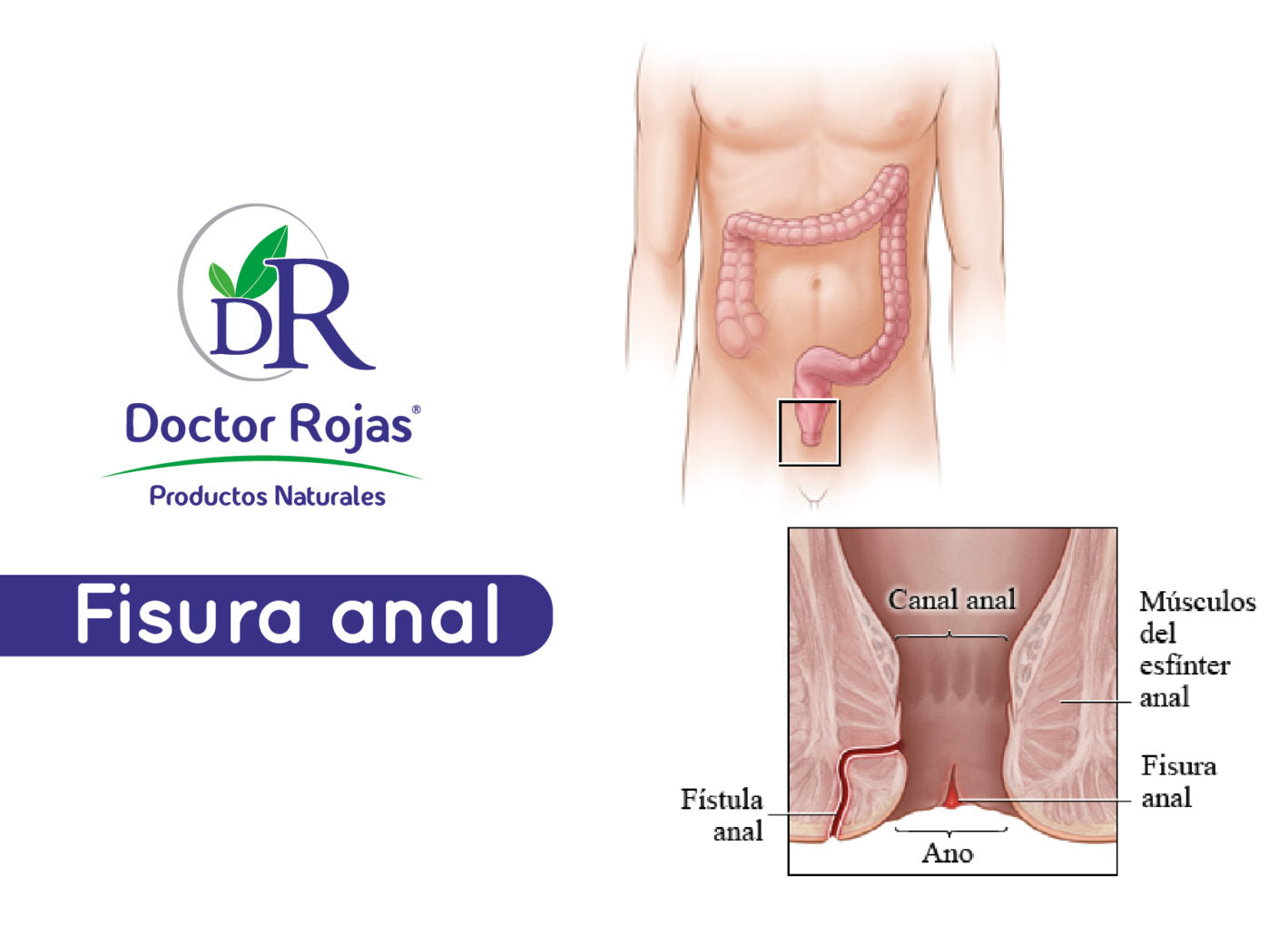 Fisura anal